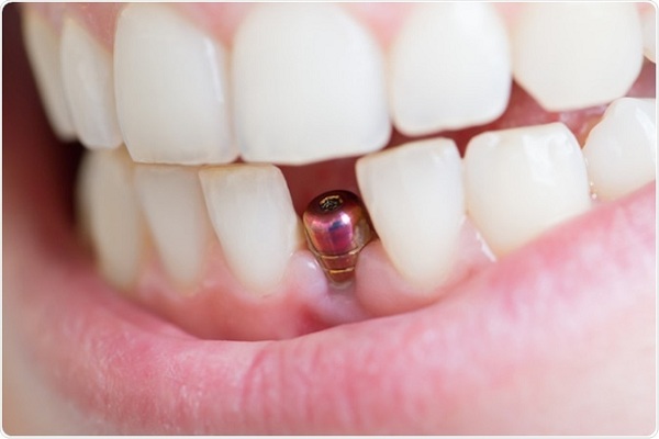 Những rủi ro khó lường trong quá trình trồng răng Implant | Nha khoa Việt Anh