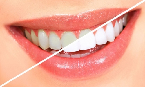 Tẩy trắng răng có phải ai cũng thực hiện được? | Nha khoa Việt Anh