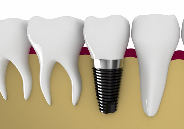 Răng Implant có cấu tạo rất giống răng thật đảm bảo tính thẩm mỹ