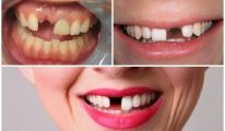 Mất răng cửa có nên trồng răng Implant?