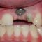 Những rủi ro khó lường trong quá trình trồng răng Implant
