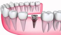Vừa nhổ răng xong có được trồng răng Implant không