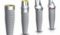 Trồng răng Implant loại nào tốt?
